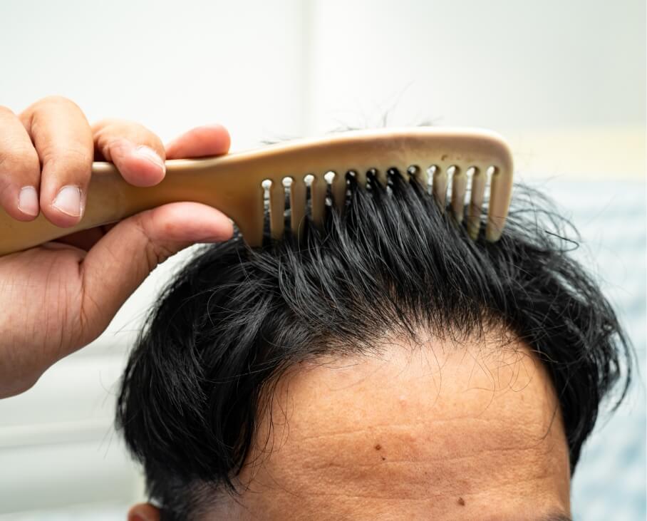 bald-at-front-of-head-and-begin-no-loss-hair-glabr-2023-11-27-05-24-04-utc (1)